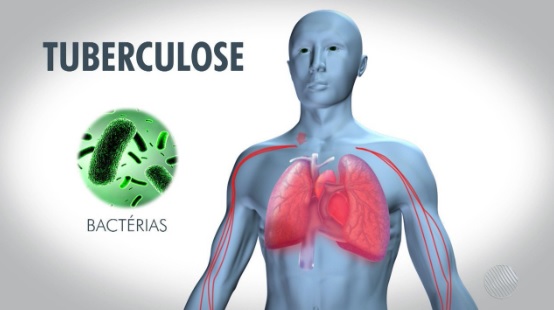  Rio Preto promove campanha sobre Tuberculose