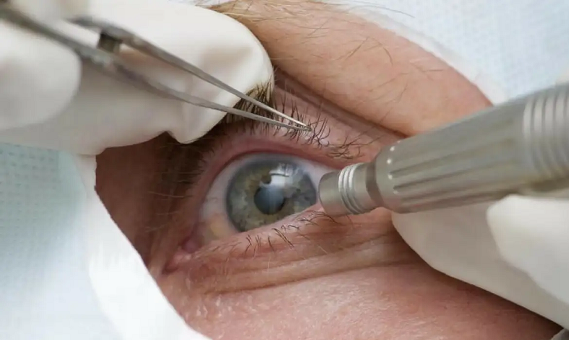  Médicos alertam para riscos de cirurgia de mudança da cor dos olhos